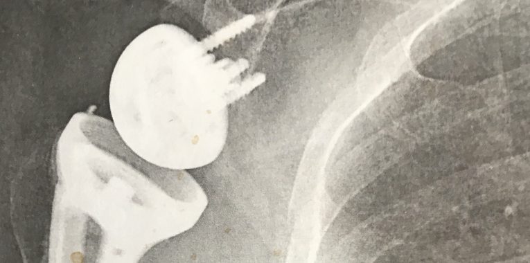 Titanium Shoulder Replacer